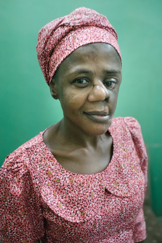 Mulikat, 33 años, antigua paciente de noma. Nigeria
