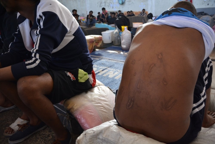 Personas refugiadas en el centro de detención de Dhar al-Jebel y Gharyan. Una persona muestra heridas y cicatrices infligidas durante su cautiverio en manos de los traficantes.